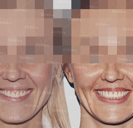 ORBIS